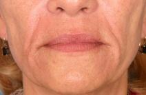 Hyaluronic Acid Before
